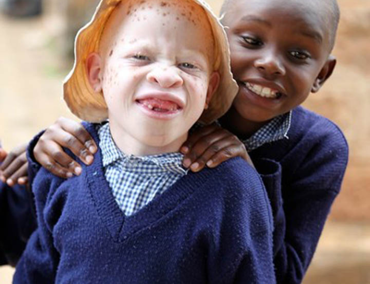 albino pupil with his friend